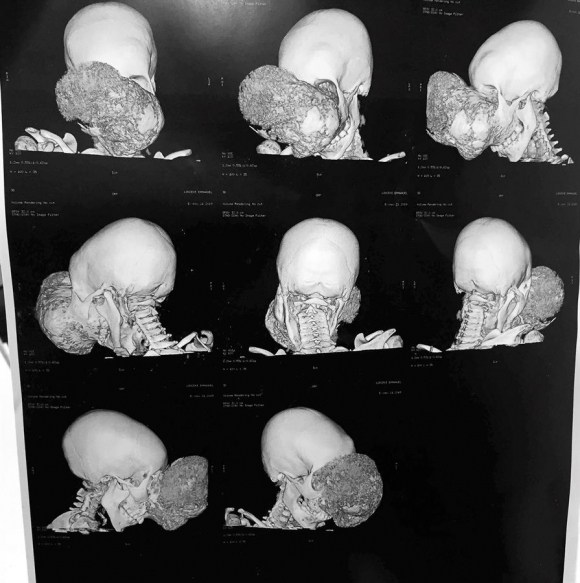 Fotografía de la radiografía del tumor de cabeza extirpado por el doctor Cavadas.