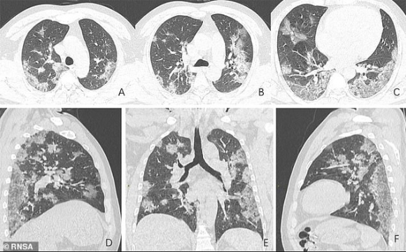 Imágenes de pulmones con coronavirus