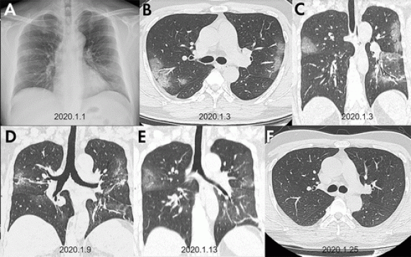 Imágenes de pulmones con coronavirus