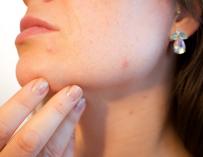 Aparatos para evitar el acné en el rostro